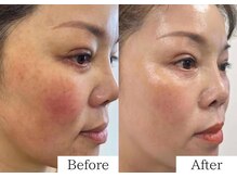 ミューズファクトリー(Muse factory)/エステでも効果は抜群♪