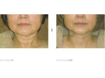 Nビューティー/最新RFサーモシェイプオーパス