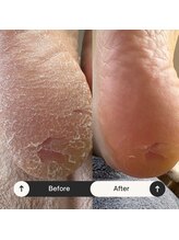 マオヌー(MAONU)/韓国式足裏角質ケア　症例写真