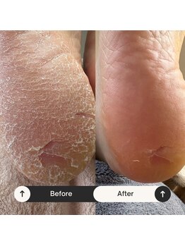 マオヌー(MAONU)/韓国式足裏角質ケア　症例写真