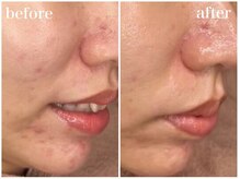 ホワイトアクア 姫路店(WHITE AQUA)/ララピール/肌荒れ/美肌/美白