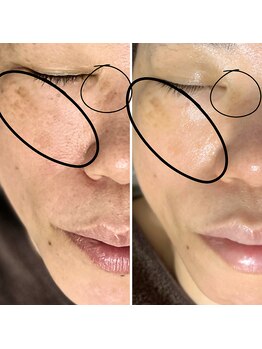 マーギアー(Magier)/ハーブ＋ダーマ　初来店→４回目