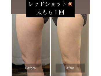 チャルム(CAL'ME)/レッドショット 太もも