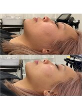 エンルーチェ プラスエイト(en;Luce+8)/脂肪分解レモンボトル