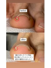 ミシュリーヌ(micheline.)/お悩み爪、巻きの補正症例