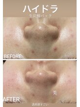 美顔秘密基地 新宮/ハイドラ毛穴洗浄