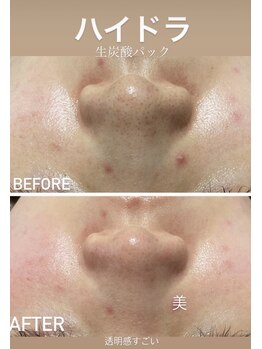 美顔秘密基地 新宮/ハイドラ毛穴洗浄