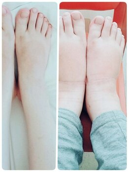 アリエッタ(Arietta)/足のむくみケア　施術前と施術後