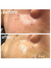 ローズ バイ フェリーチェ(Rose by felice)/【毛穴ケア】毛穴が目立たない☆