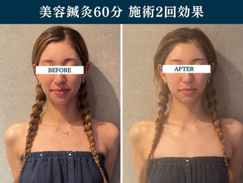 シンク(CINQ)/美容鍼灸60分小顔むくみ解消鍼灸