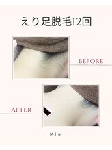 ミュウ(Miu.)/脱毛before/after