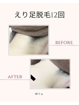 ミュウ(Miu.)/脱毛before/after