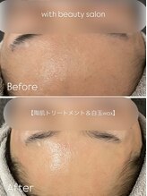 ウィズ(with)/REVIハーブピーリング×白玉WAX