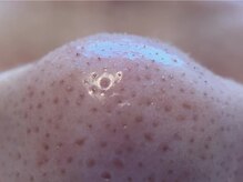 リセットプラス(Reset+)/お鼻の産毛目立っていませんか？