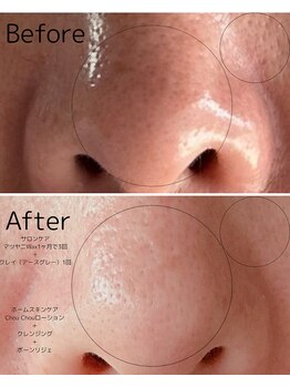 ポロカ(POLOKA)/マツヤニホットセラピー