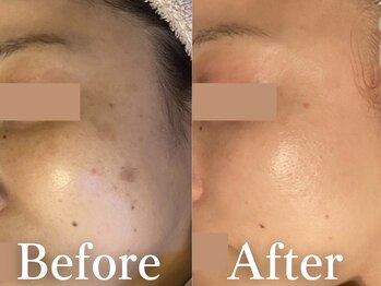 リシェス(Richesse)/シミ、毛穴、くすみ等の同時ケア