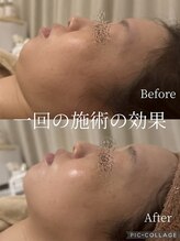 ラムール(L'amour)/リフトアップ