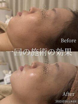 ラムール(L'amour)/リフトアップ