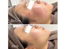 ニキビ研究所 千葉店の雰囲気（今まで何をしても結果が出なかった方！ニキビ研究が解決します！）