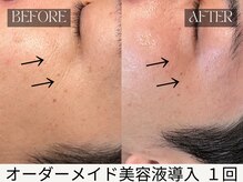 スキンジム(SKIN GYM)/美容液導入で小皺＋くすみ改善