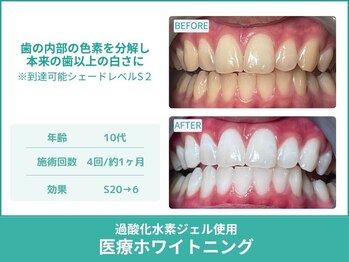 クレア(Crea)/【歯のホワイトニング症例写真】