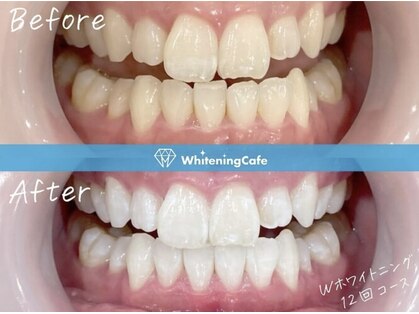 歯のホワイトニングWhiteningCafe練馬店【ホワイトニングカフェ】の写真