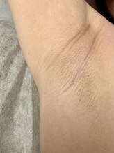 ヴィプラス(VIPLUZ)/人気No２の脇脱毛で臭い対策を