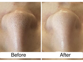 ビューティースタジオ ハンミ 福岡大名店(Beauty studio 韓美)/３Ｄ毛穴幹細胞コース