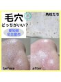 ボニータ(Bonita) 【毛穴エクストラクションtete式】こんなにキレイになります♪