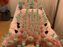 銀座ときた鍼灸治療院/＊施術風景＊カッピング