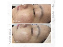 シャルムパリス(charme paris)/アクネ菌殺菌☆１回の施術変化