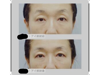 アリウム(Allium)/アイリフト