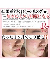 ホワイトアクア 新宿本店(WHITE AQUA)/ハーブピーリング/東京/新宿