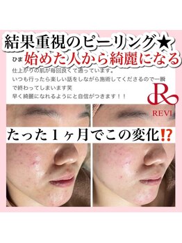 ホワイトアクア 新宿本店(WHITE AQUA)/ハーブピーリング/東京/新宿