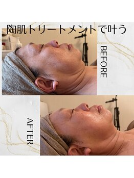 キラリ(Kirari)/次世代ハーブピーリング