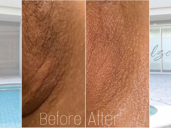 ベルゼ 渋谷店(BELZE)/黒ずみ・たるみに！フェムケア