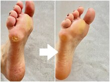 アプレラプリュイ シァル鶴見店(APRES LA PLUIE)の雰囲気（マシンでしっかり角質ケア☆シルキーコース¥11000）