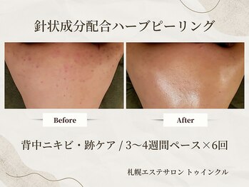 プライベートエステサロン トゥインクル/背中上部のニキビ・跡を集中ケア