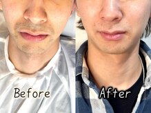 エジェリビューティー 恵比寿(egerie beauty)/髭脱毛・全顔、顎下10回照射後