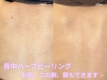 リリーイー(LILY E)の雰囲気（自分でケアしにくいお背中はお任せ下さい。ブライダル前にも。）