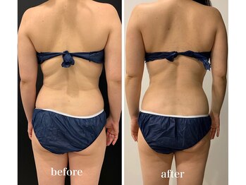 スパチャーレ(Spa ciare)/フォースカッター 90分8回