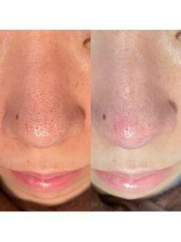 ミニョンプラス(Mignon+)/毛穴が変わると肌が変わる