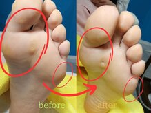 ドクターネイル爪革命 長野店/【たこ・うおのめ】リラク/足裏