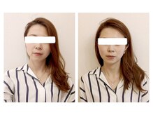 ウォーブ(Wobe)/施術一回でフェイスラインが…