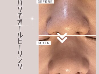 ザ エステティック福岡/バクチオールピーリング