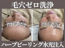 マヴィ くずは店(MavY.)/ピーリング＋水光注入最高です！