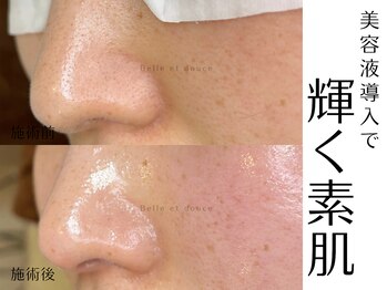 ベルエドゥース(Belle et Douce)/韓国へ行かなくてもできる肌管理