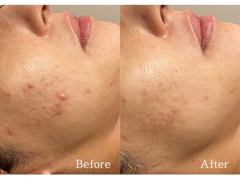 綺麗サロン 脱毛アンドフェイシャル ジュエル(Jewel)/【4BミネラルクリアTR】