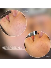 モモ(Momo.)/ハーブピーリング
