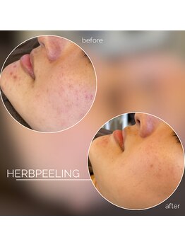 モモ(Momo.)/ハーブピーリング